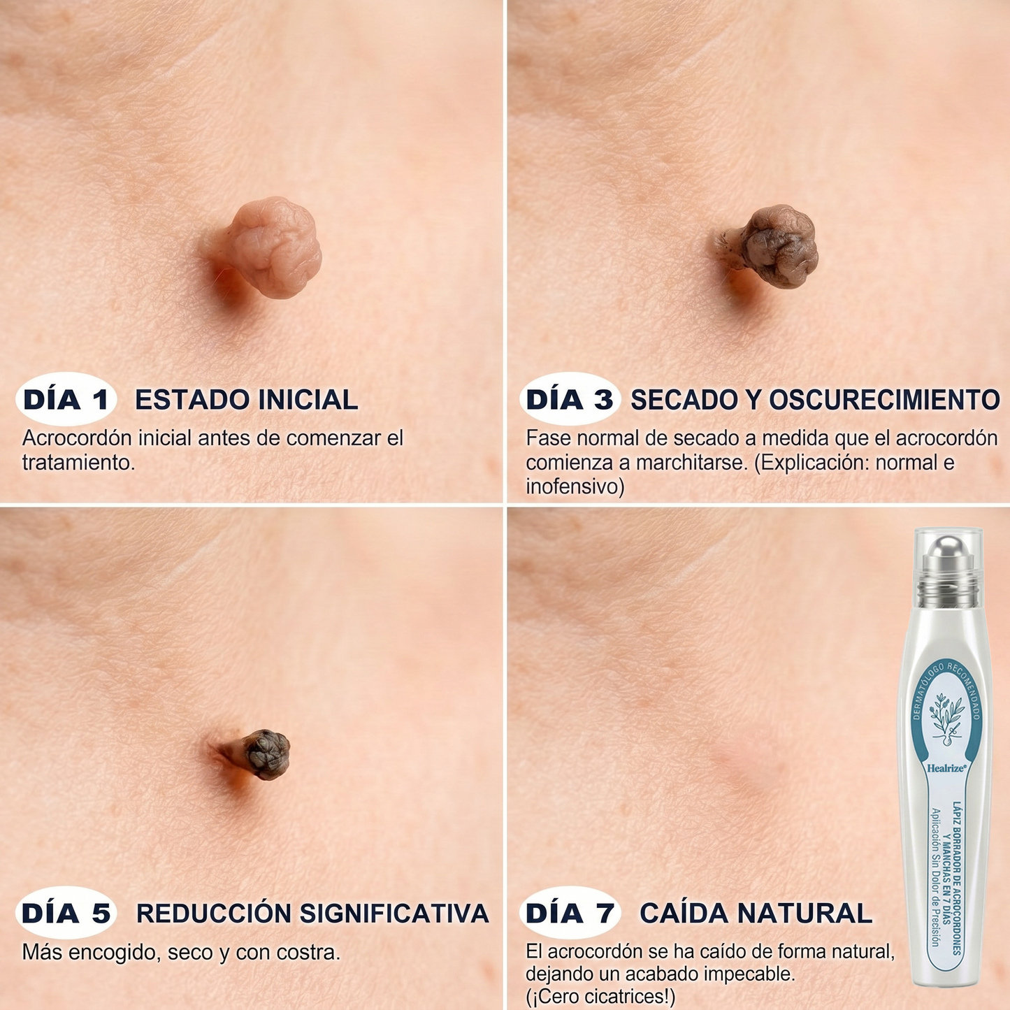 🍠𝐓𝐢𝐞𝐧𝐝𝐚 𝐨𝐟𝐢𝐜𝐢𝐚𝐥 𝐝𝐞 𝐥𝐚 𝐦𝐚𝐫𝐜𝐚  𝐇𝐞𝐚𝐥𝐫𝐢𝐳𝐞® 𝐁𝐨𝐫𝐫𝐚𝐝𝐨𝐫 𝐝𝐞 𝐕𝐞𝐫𝐫𝐮𝐠𝐚𝐬 𝐲 𝐌𝐚𝐧𝐜𝐡𝐚𝐬 𝐝𝐞 𝟕 𝐃í𝐚𝐬(Roll-on Cero Dolor, Cero Cicatrices)